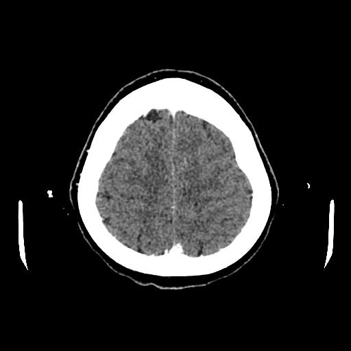 Cerebral venous thrombosis with venous hemorrhagic infarct (Radiopaedia 90354-107660 Axial with contrast 137).jpg