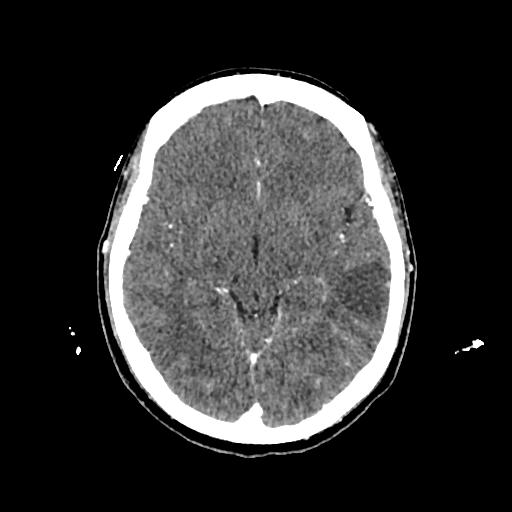 Cerebral venous thrombosis with venous hemorrhagic infarct (Radiopaedia 90354-107660 Axial with contrast 76).jpg