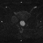 Cervical adenocarcinoma (Radiopaedia 65011-73985 Axial DWI 45).jpg