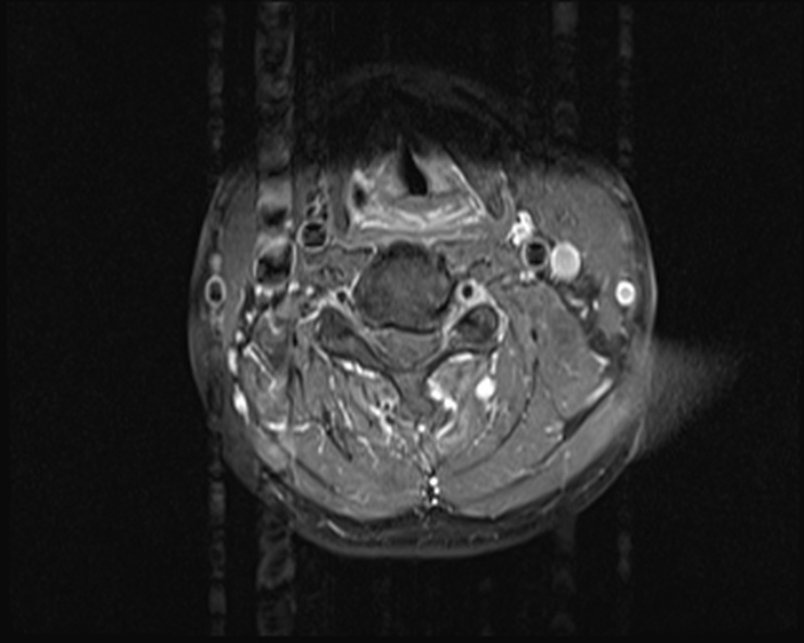 File:Cervical disc extrusion (Radiopaedia 53950-60077 Axial T1 C+ fat sat 12).jpg
