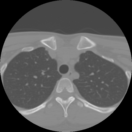 Cervical rib (Radiopaedia 71110-81363 Axial non-contrast 61).jpg