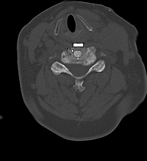 File:Cervical spine ACDF loosening (Radiopaedia 48998-54070 Axial bone window 36).png