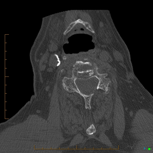 Cervical spine fracture - ankylosing spondylitis (Radiopaedia 76835-88706 Axial bone window 124).jpg