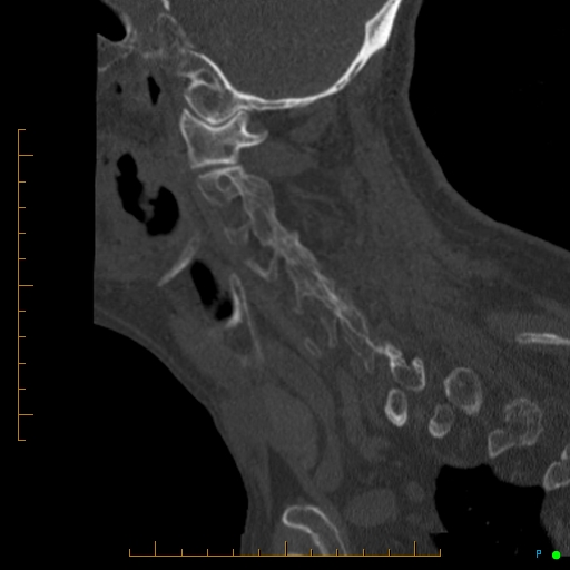 Cervical spine fracture - ankylosing spondylitis (Radiopaedia 76835-88706 Sagittal bone window 81).jpg