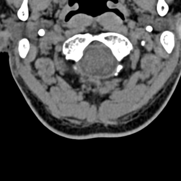 File:Cervical spondylodiscitis (Radiopaedia 28057-29489 Axial non-contrast 13).jpg
