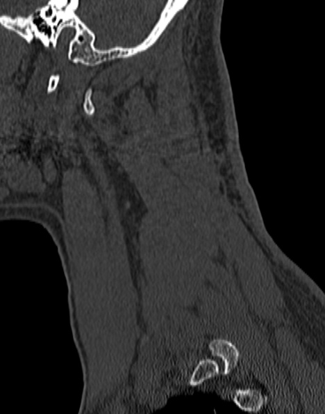 Cervical spondylodiscitis (Radiopaedia 28057-29489 Sagittal bone window 13).jpg