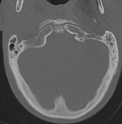 File:Cervical spondylolysis (Radiopaedia 49616-54811 Axial bone window 8).png