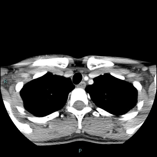Cervical thymic cyst (Radiopaedia 88632-105335 C 21).jpg