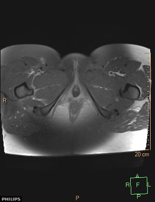 File:Cesarian scar endometriosis (Radiopaedia 68495-78066 Axial T1 C+ fat sat 28).jpg