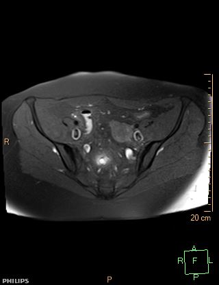 File:Cesarian scar endometriosis (Radiopaedia 68495-78066 Axial T1 fat sat 7).jpg