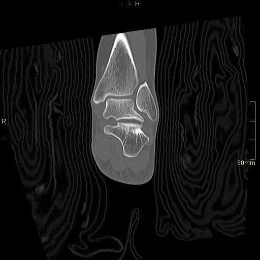 Chaput tubercle fracture (Radiopaedia 80319-93956 Coronal non-contrast 41).jpg