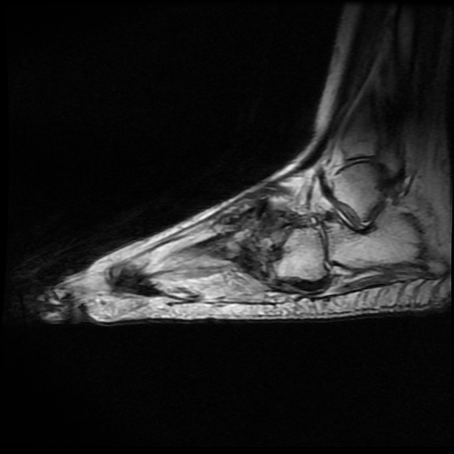 File:Charcot arthropathy (Radiopaedia 55056-61422 Sagittal T2 13).jpg