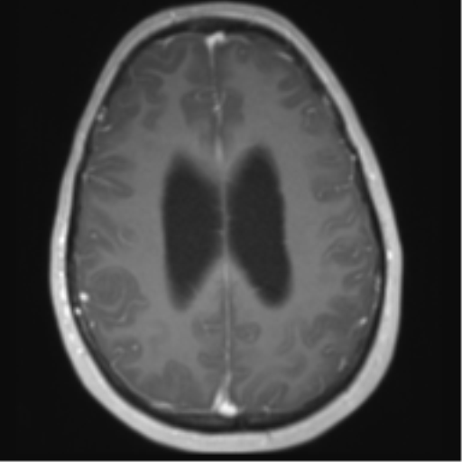 File:Chiari I malformation and obstructive hydrocephalus (Radiopaedia 41185-43978 Axial T1 C+ 23).png