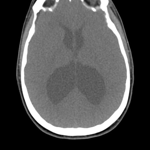 Chiari I malformation and obstructive hydrocephalus (Radiopaedia 41185-43981 D 9).png