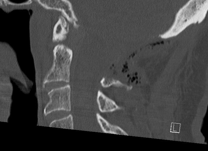 Chiari I malformation with a symptomatic syrinx of the posterolateral medulla oblongata (Radiopaedia 42573-45707 A 27).jpg