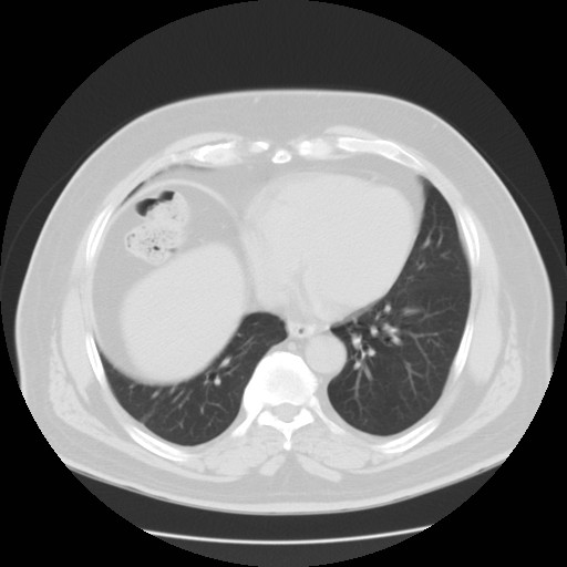 File:Chilaiditi’s syndrome (Radiopaedia 27550-27756 Axial lung window 10).jpg