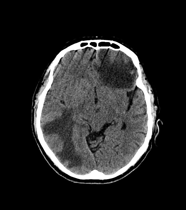 Cholangiocarcinoma with cerebral metastases (Radiopaedia 83519-98628 Axial non-contrast 32).jpg