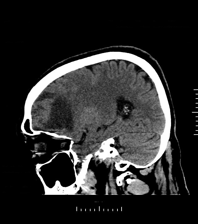 Cholangiocarcinoma with cerebral metastases (Radiopaedia 83519-98628 C 37).jpg