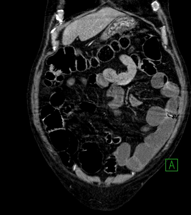 Cholangiocarcinoma with cerebral metastases (Radiopaedia 83519-98629 E 22).jpg