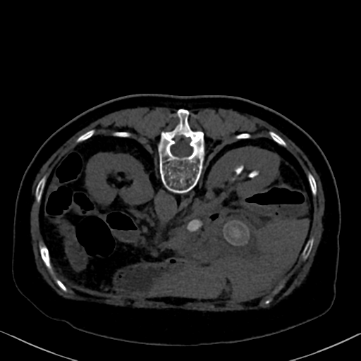 File:Cholecystitis - obstructive choledocholitiasis (CT intravenous cholangiography) (Radiopaedia 43966-47479 Axial 10).png