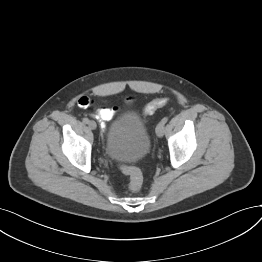 Cholecystitis with focal perforation and hepatic abscess (Radiopaedia 37189-38945 Axial non-contrast 75).png