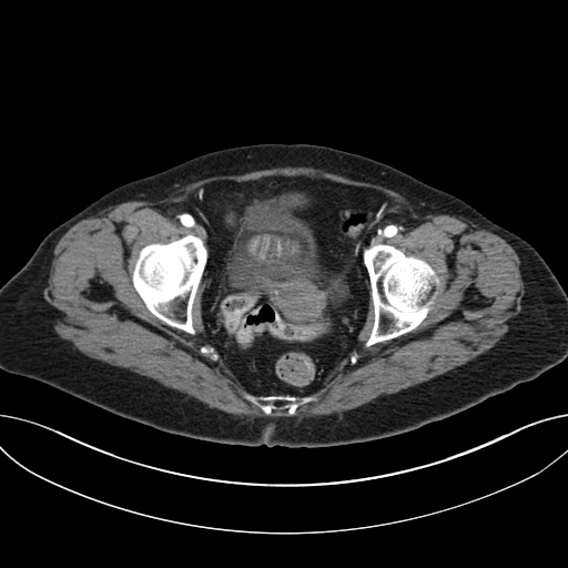 Cholecystoduodenal fistula due to calculous cholecystitis with gallstone migration (Radiopaedia 86875-103077 A 67).jpg