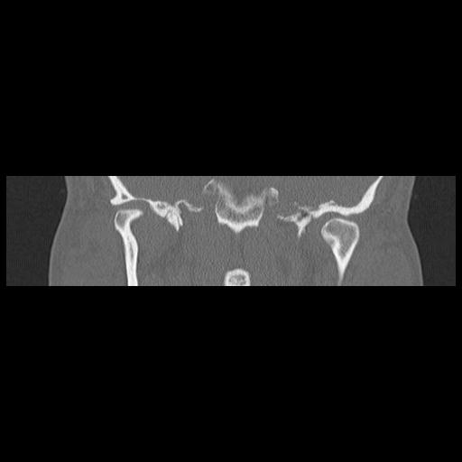 File:Cholesteatoma (Radiopaedia 84946-100455 Coronal bone window 86).jpg