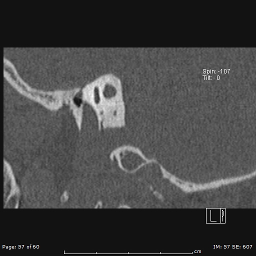 Cholesteatoma - external auditory canal (Radiopaedia 88452-105096 Sagittal bone window 57).jpg