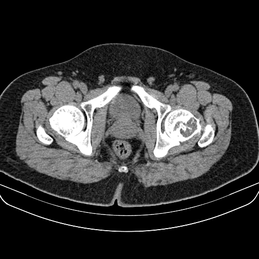 File:Chondroblastoma (Radiopaedia 12264-12563 Axial non-contrast 6).jpg
