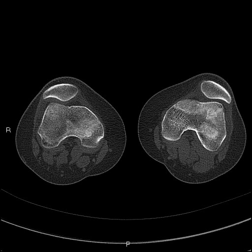 File:Chondroblastoma (Radiopaedia 62721-71030 Axial bone window 1).jpg