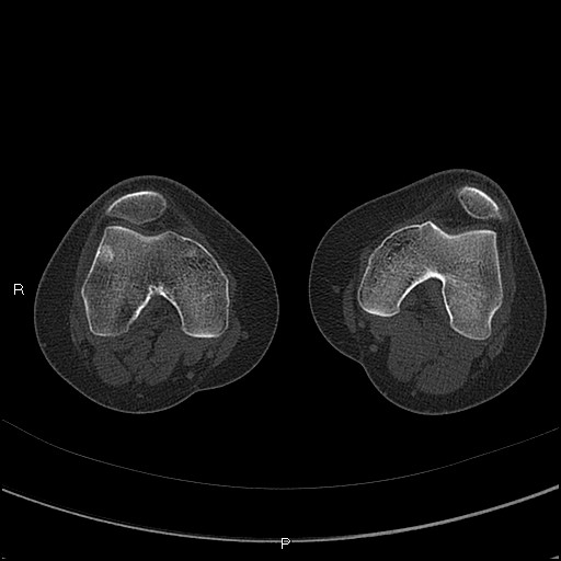 Chondroblastoma (Radiopaedia 62721-71030 Axial bone window 13).jpg