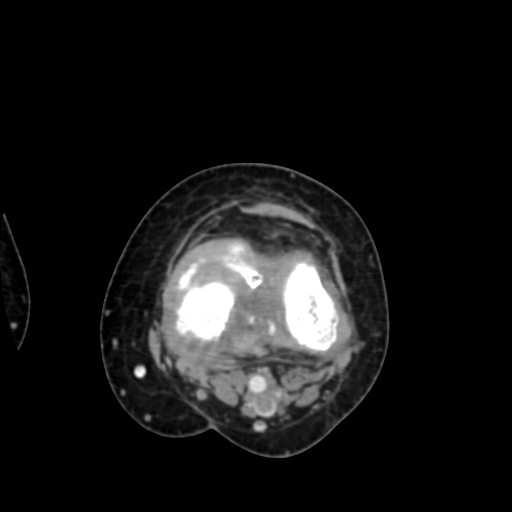 Chondrosarcoma - femur (Radiopaedia 64187-72954 Axial with contrast 55).jpg
