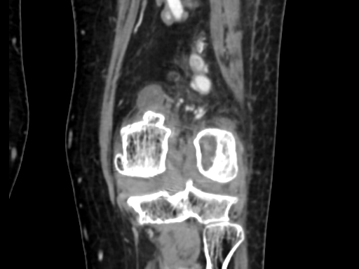Chondrosarcoma - femur (Radiopaedia 64187-72954 C 41).jpg