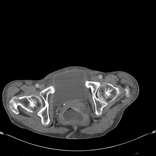 Chondrosarcoma of the spine (Radiopaedia 49871-55143 A 62).jpg