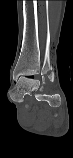 Chopart fracture (Radiopaedia 35347-36851 Coronal bone window 34).jpg