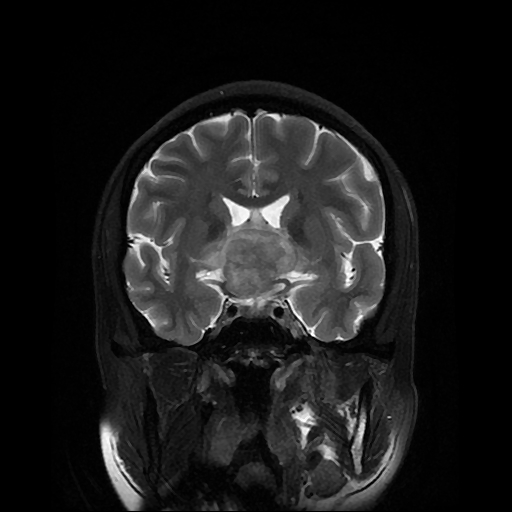File:Chordoid glioma of third ventricle (Radiopaedia 91612-109340 Coronal T2 12).jpg