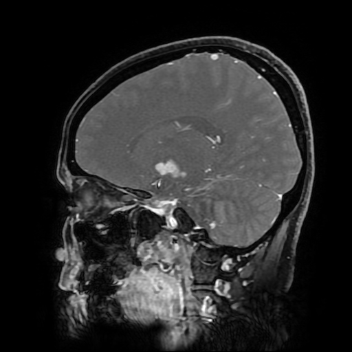 File:Chordoid glioma of third ventricle (Radiopaedia 91612-109340 F 127).jpg