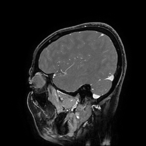 File:Chordoid glioma of third ventricle (Radiopaedia 91612-109340 F 57).jpg