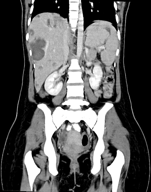 Choriocarcinoma liver metastases (Radiopaedia 74768-85766 B 64).jpg