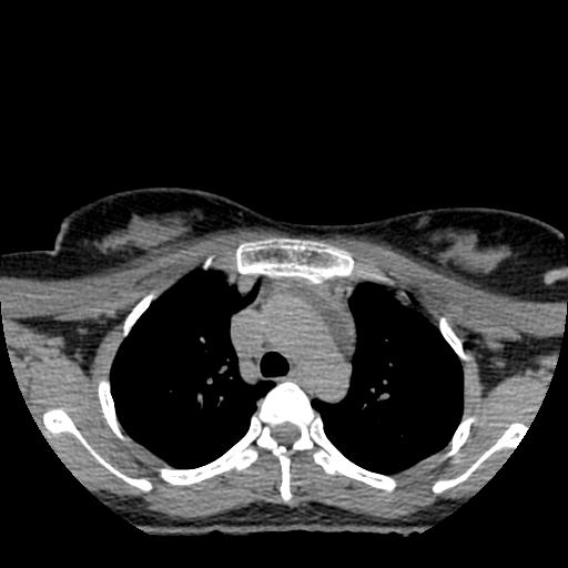 File:Choriocarcinoma of ovary with cerebral and pulmonary metastases (Radiopaedia 25983-26119 Axial non-contrast 108).jpg