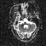File:Choroid plexus xanthogranuloma - unilateral (Radiopaedia 85632-101393 Axial ADC 15).jpg