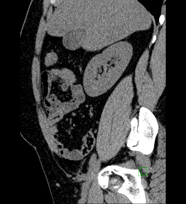 Chromophobe renal cell carcinoma (Radiopaedia 84286-99573 C 128).jpg