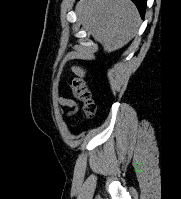 Chromophobe renal cell carcinoma (Radiopaedia 84286-99573 C 169).jpg