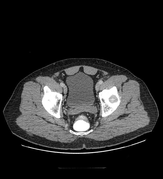 Chromophobe renal cell carcinoma (Radiopaedia 84337-99644 C 122).jpg
