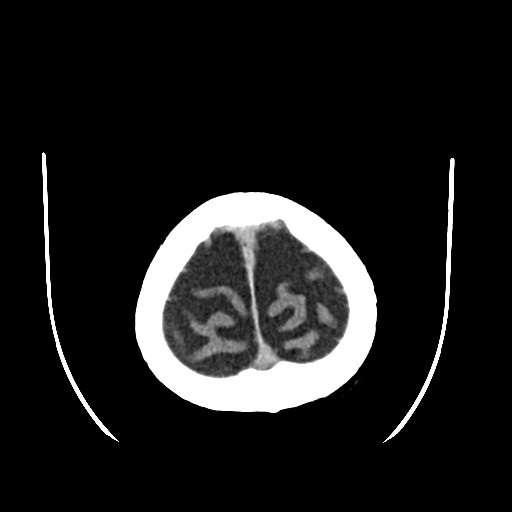 Chronic bilateral subdural hygroma (Radiopaedia 85801-101622 Axial non-contrast 65).jpg