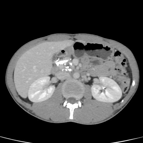 File:Chronic calcific pancreatitis (Radiopaedia 56280-62953 C 21).jpg