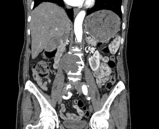 File:Chronic contained rupture of abdominal aortic aneurysm with extensive erosion of the vertebral bodies (Radiopaedia 55450-61901 D 40).jpg