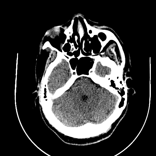 Chronic invasive fungal sinusitis (Radiopaedia 91563-109286 Axial non-contrast 24).jpg