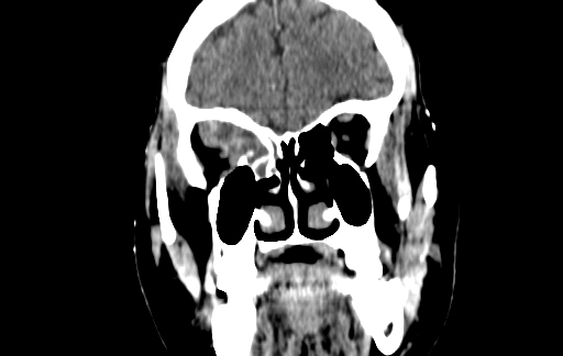 Chronic invasive fungal sinusitis (Radiopaedia 91563-109286 D 41).jpg