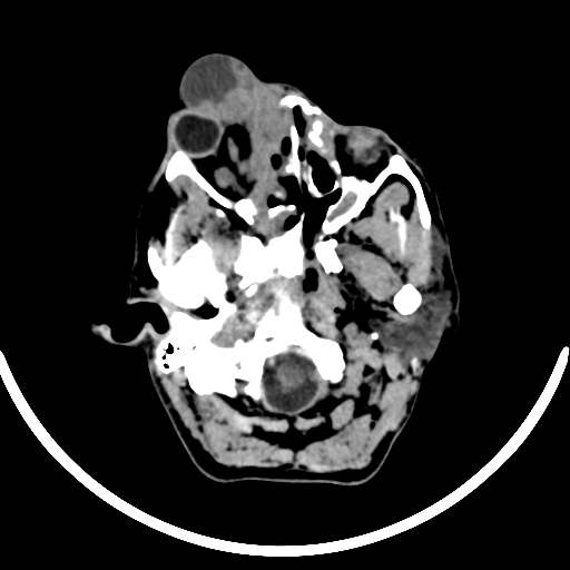 File:Chronic invasive fungal sinusitis with intraorbital and intracranial extension (Radiopaedia 56387-63046 Axial non-contrast 94).jpg